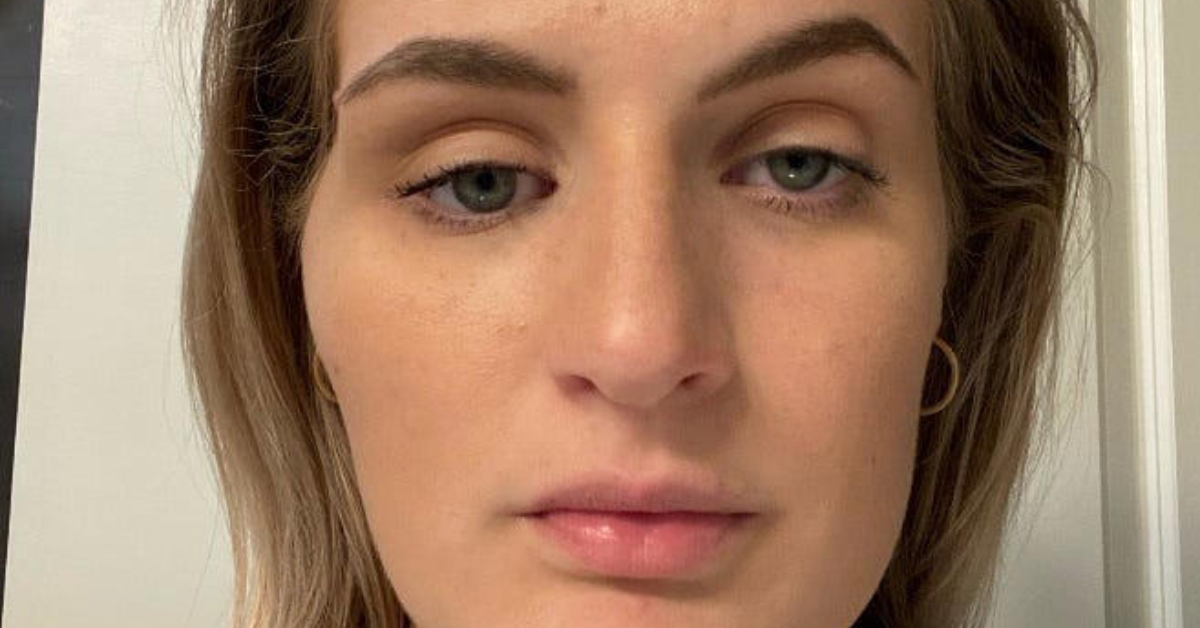 How a Rare Venous Malformation Led to Life-Changing Surgery